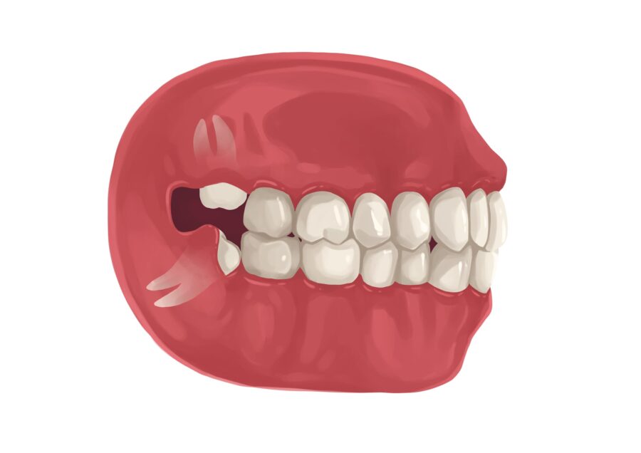 Illustration of a mouth that has problematic wisdom teeth that need to be removed