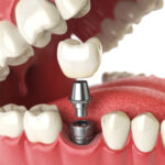 Closeup of a dental implant replacing a missing tooth in an artificial mouth