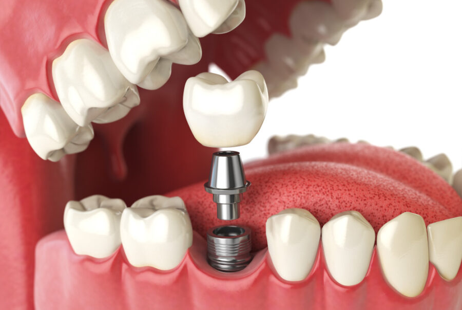 Closeup of a dental implant replacing a missing tooth in an artificial mouth
