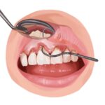Illustration of a mouth with gum disease receiving a scaling and root planing treatment