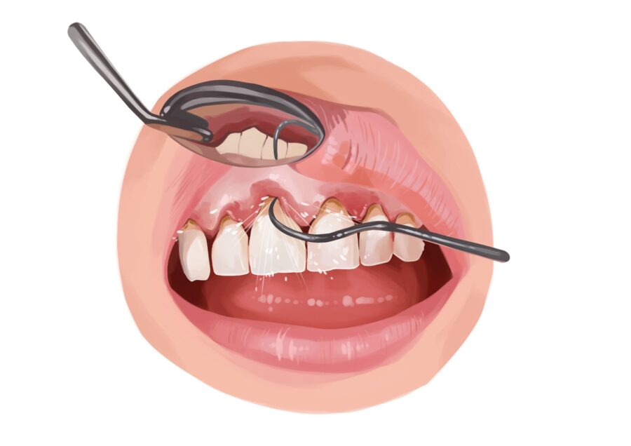 Illustration of a mouth with gum disease receiving a scaling and root planing treatment