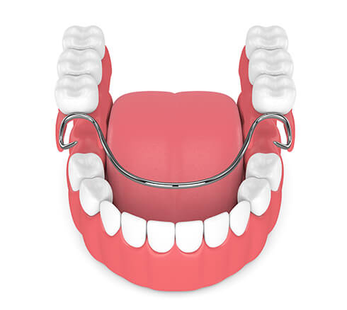 illustration of a set of partial dentures