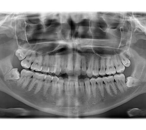 dental x-ray showing impacted wisdom teeth